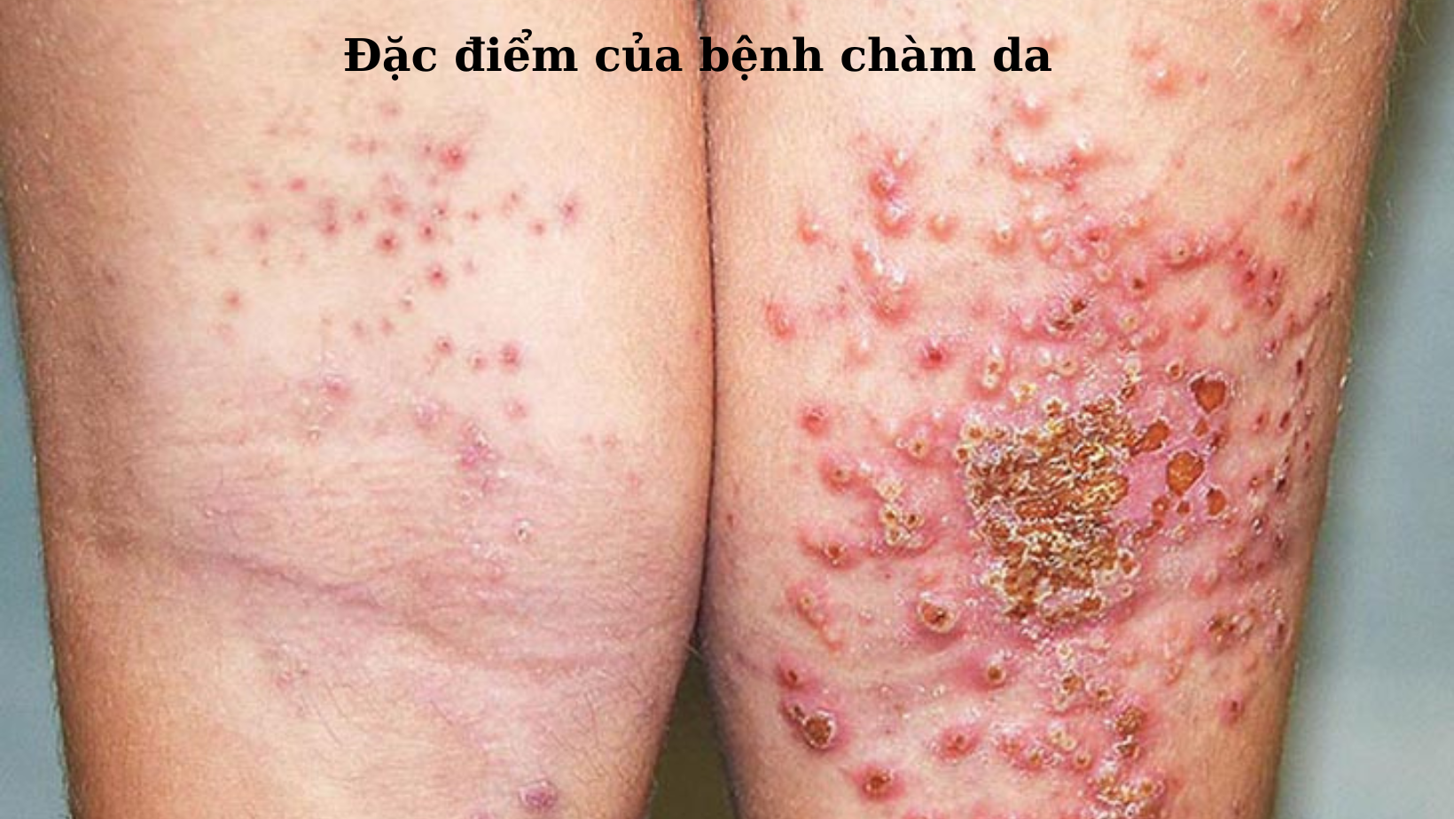 Đặc điểm của bệnh chàm da