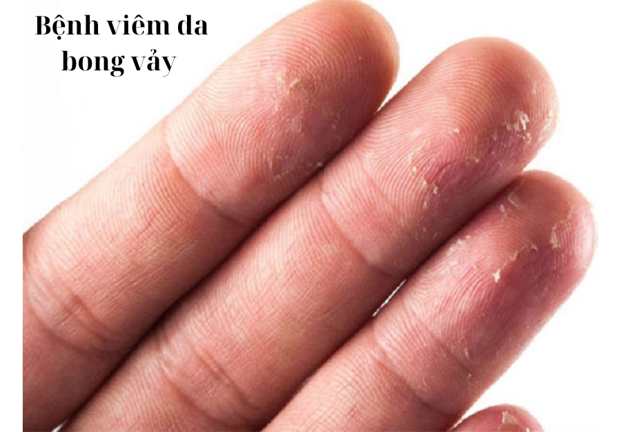 Da đóng vảy, khô, nứt sâu có thể là biểu hiện của bệnh gì?