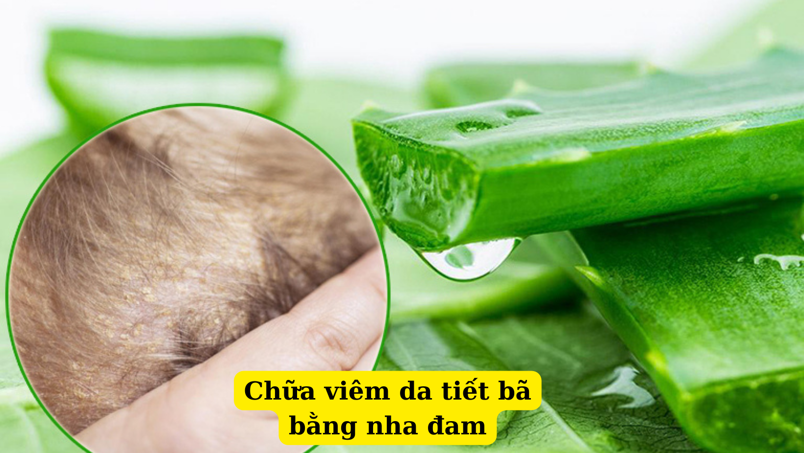 5 cách chữa viêm da tiết bã theo dân gian hiệu quả nhất