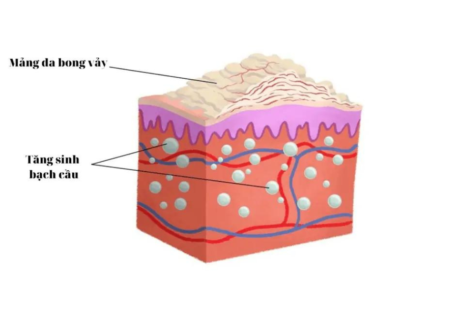 Da đóng vảy, khô, nứt sâu có thể là biểu hiện của bệnh gì?