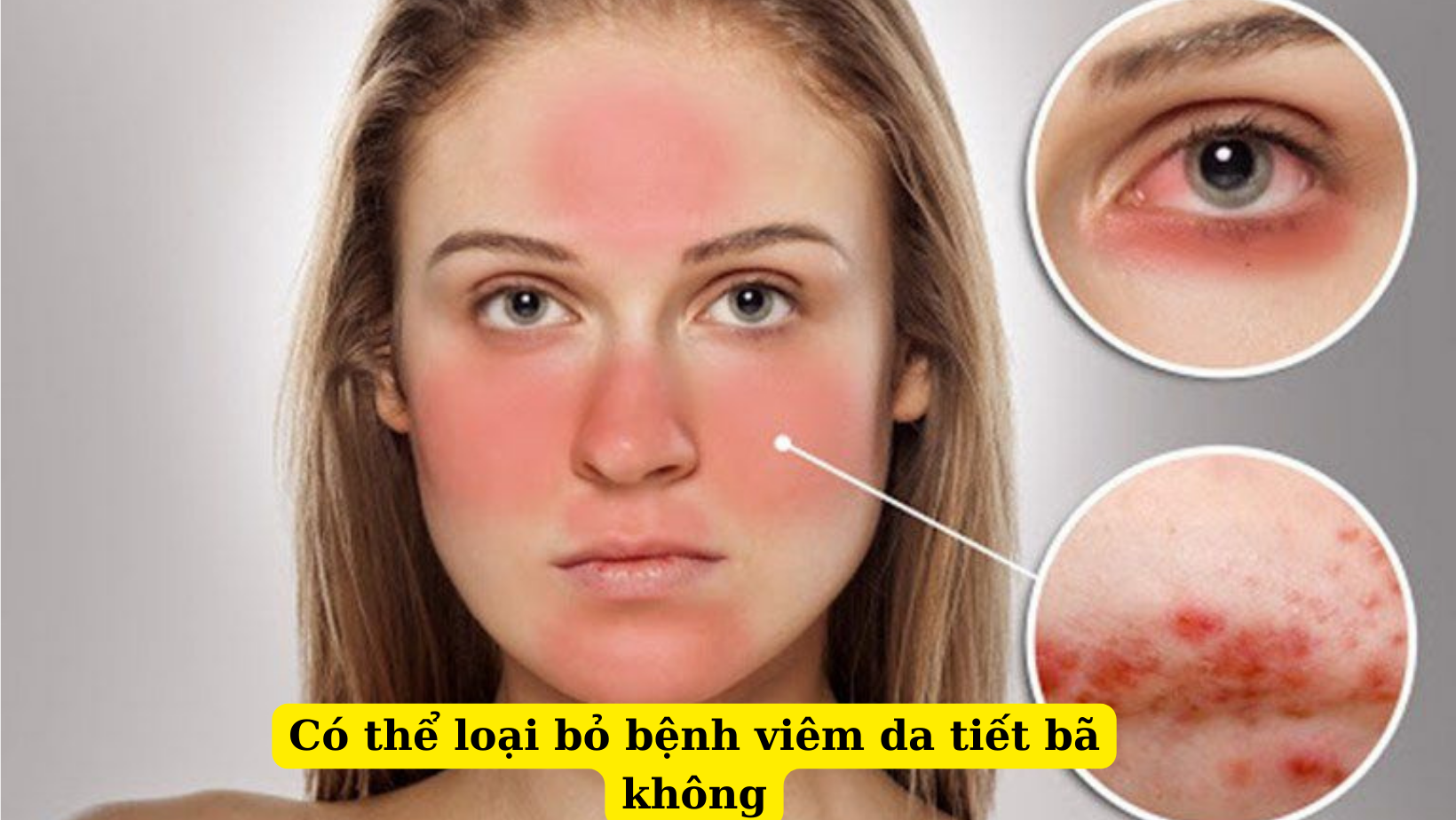 Tôi đã loại bỏ viêm da tiết bã như thế nào?