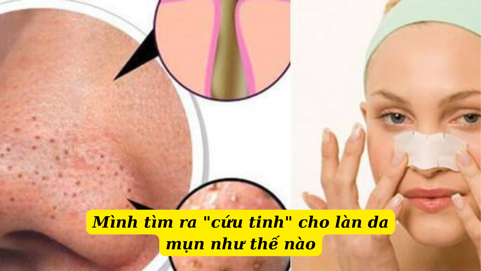 Điều trị mụn mủ hiệu quả bằng việc áp dụng phương pháp điều trị mới