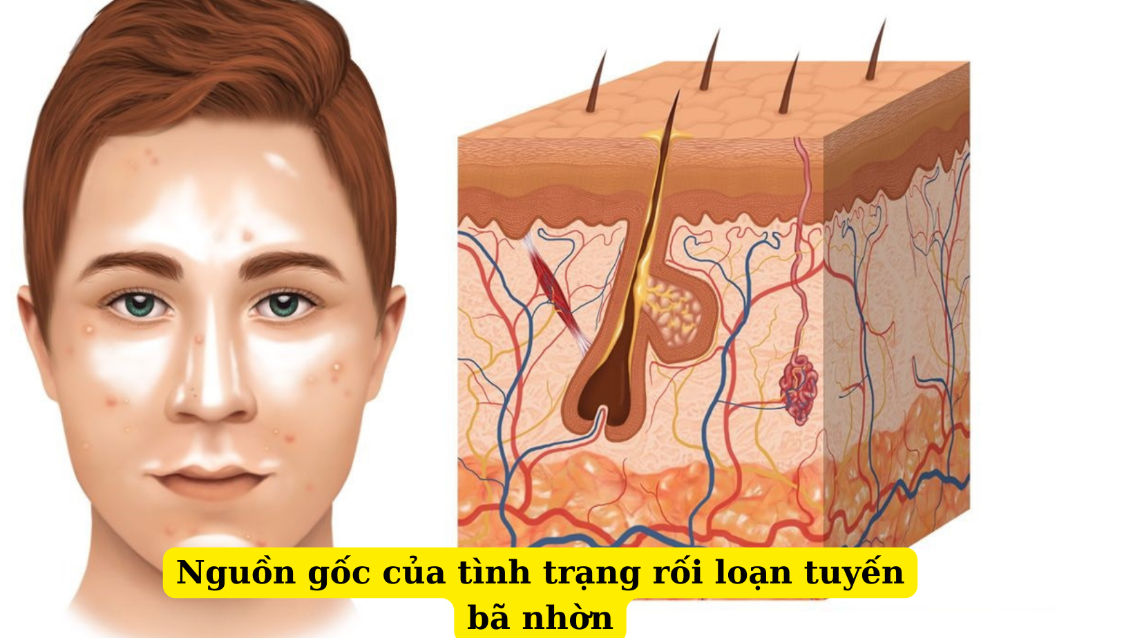 Rối loạn tiết bã nhờn và những phiền toái mà chúng gây nên