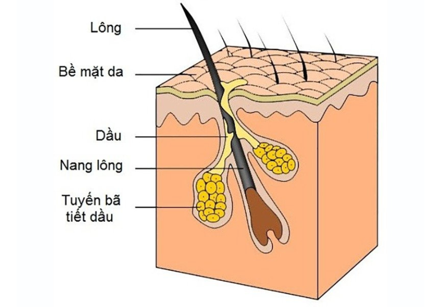 Sợi bã nhờn gây bệnh gì bạn đã biết chưa?