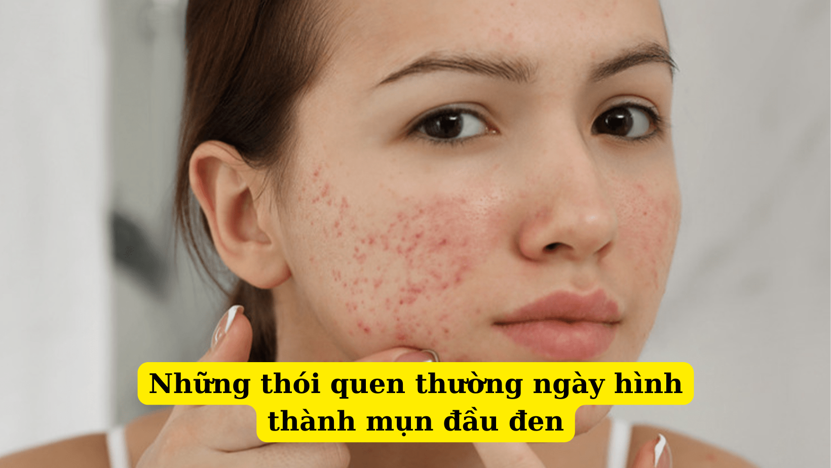 Mình đã điều trị thành công mụn đầu đen nhờ áp dụng những cách dưới đây