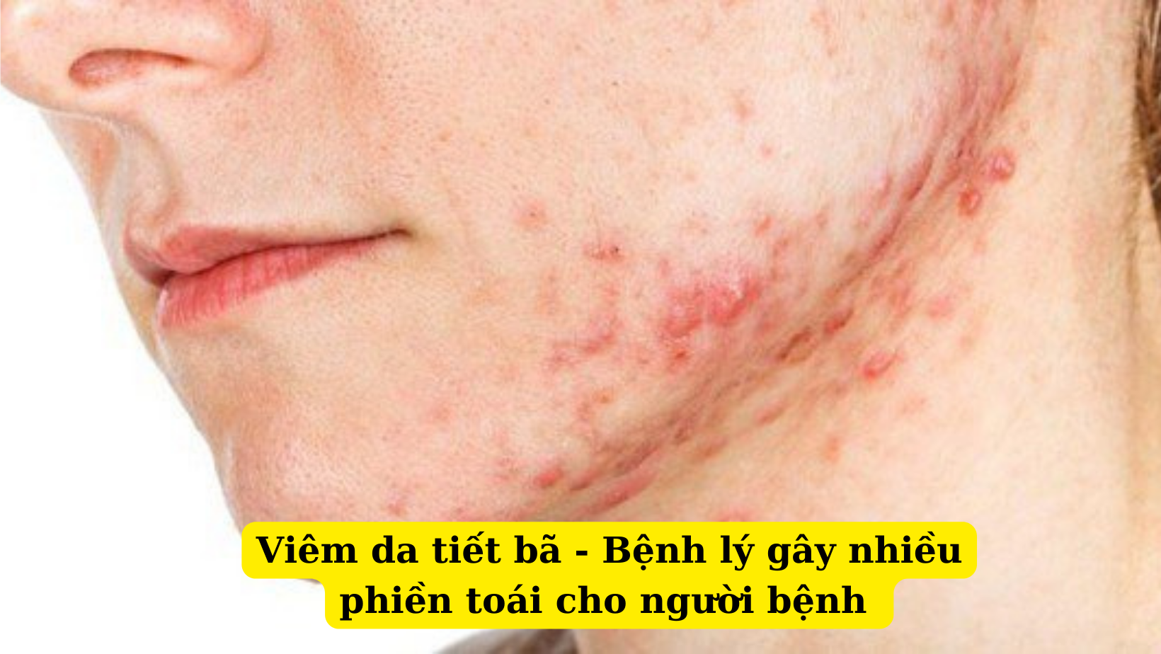 Những nguyên nhân dễ gây nên bệnh viêm da tiết bã