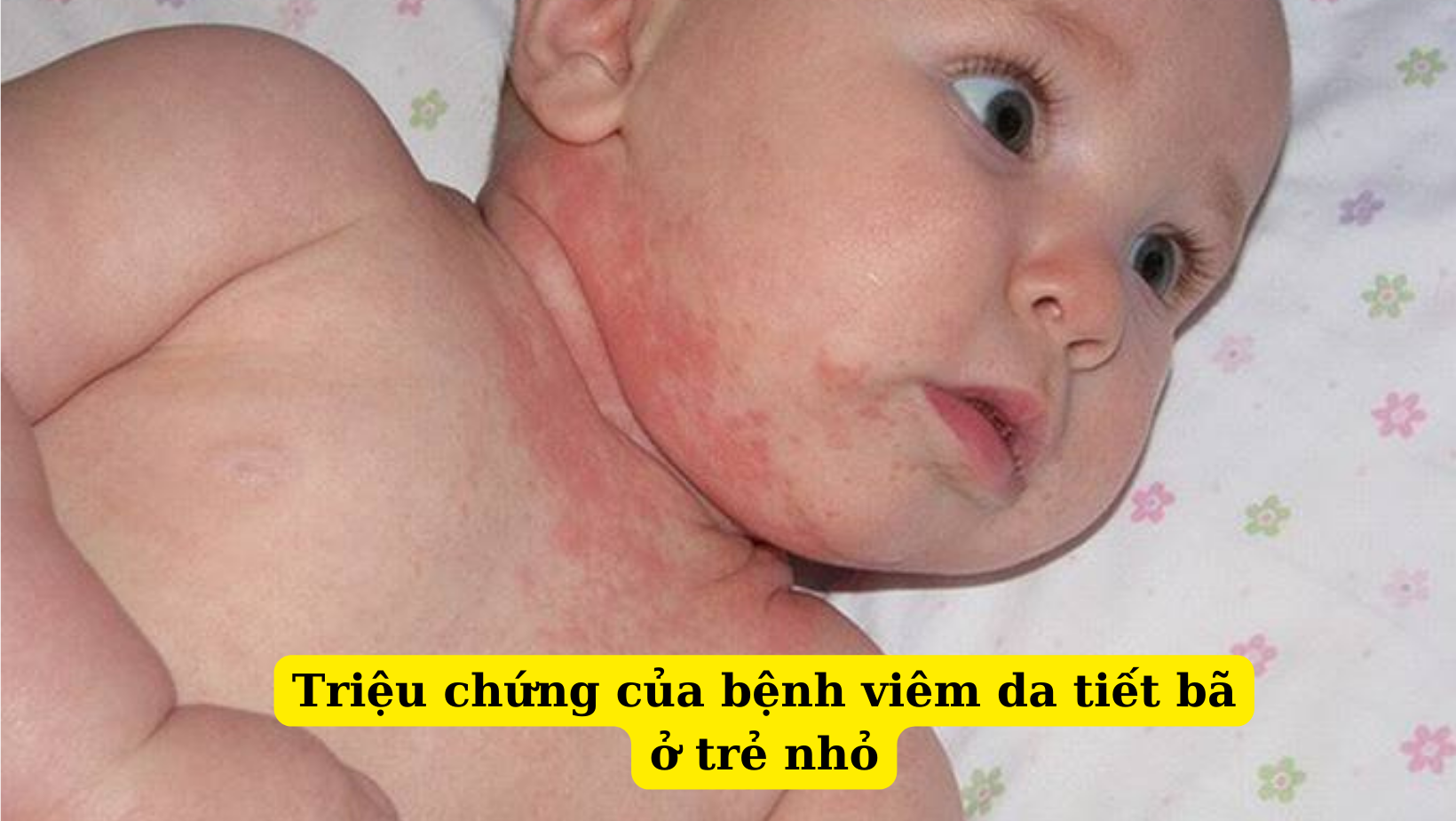 Những nguyên nhân dễ gây nên bệnh viêm da tiết bã