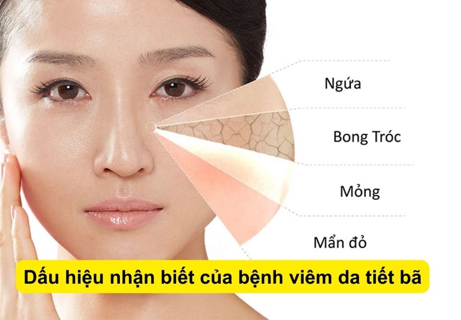 Viêm da tiết bã và những điều cần biết