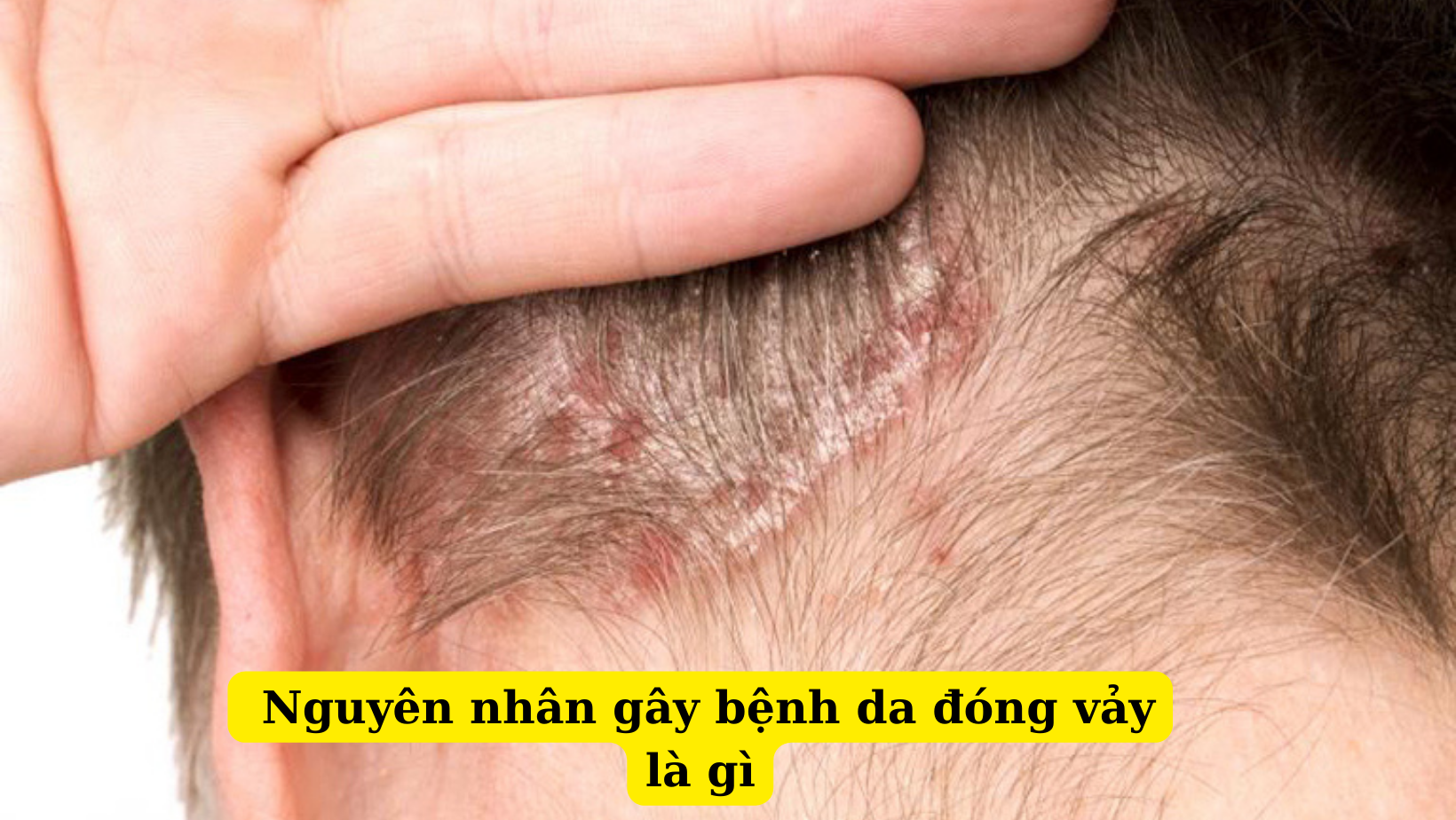 Nguyên nhân làm da đóng vảy có thể bạn không biết