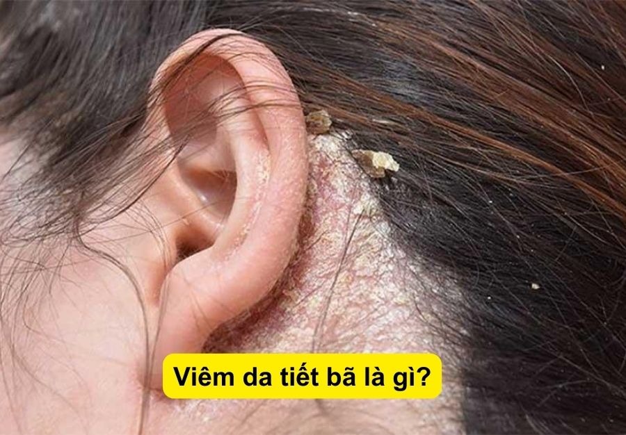 Viêm da tiết bã và những điều cần biết